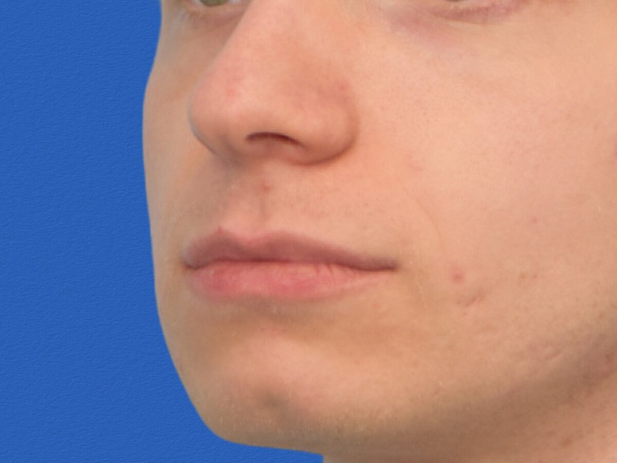 Lip Lift Before & After Image