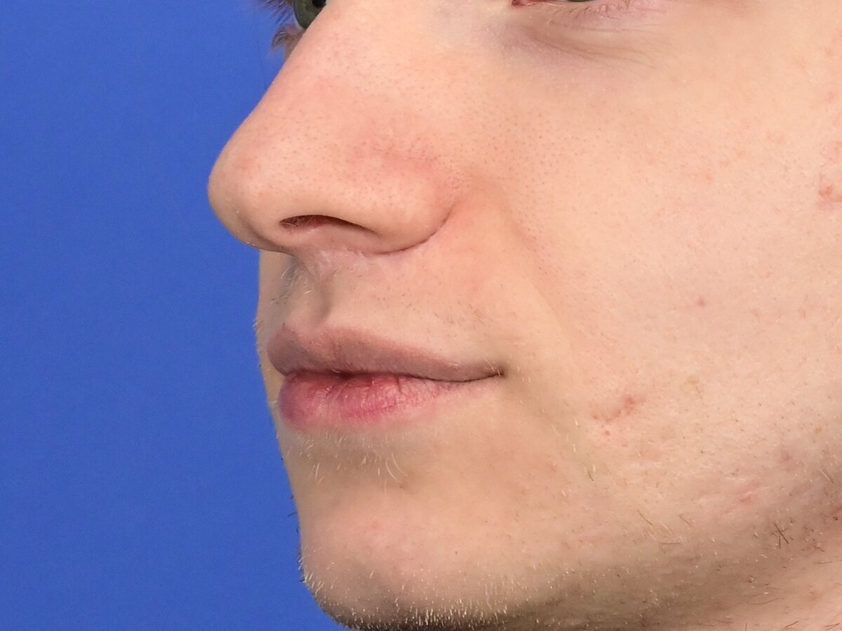 Lip Lift Before & After Image