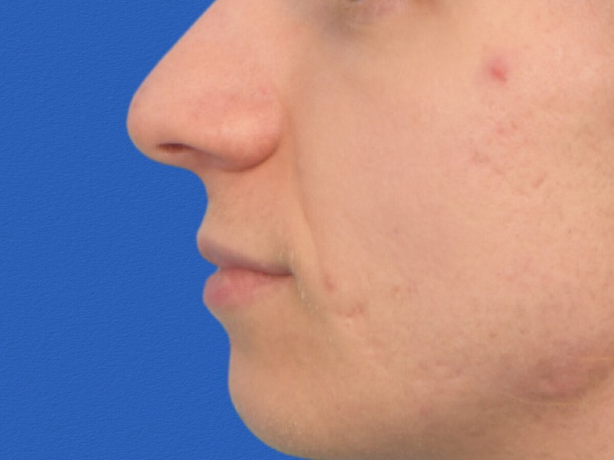 Lip Lift Before & After Image