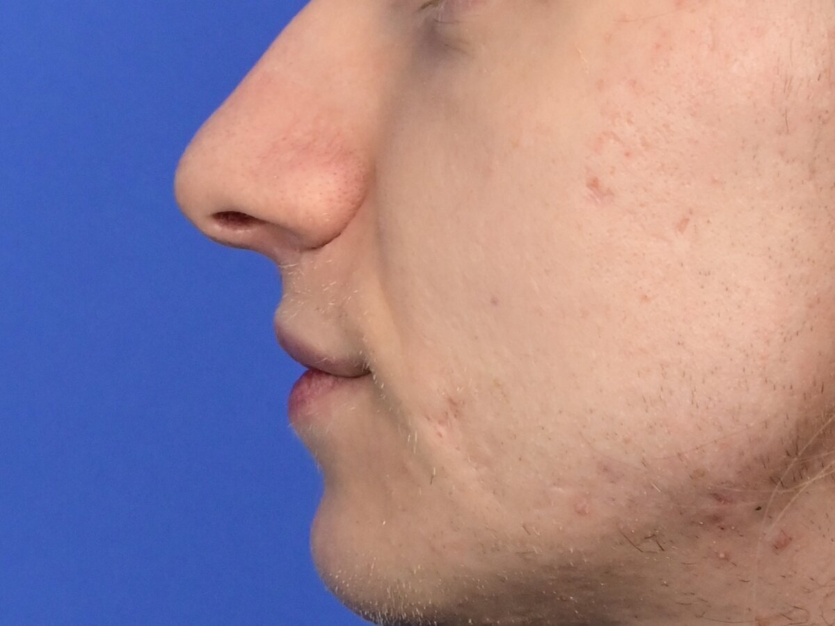 Lip Lift Before & After Image