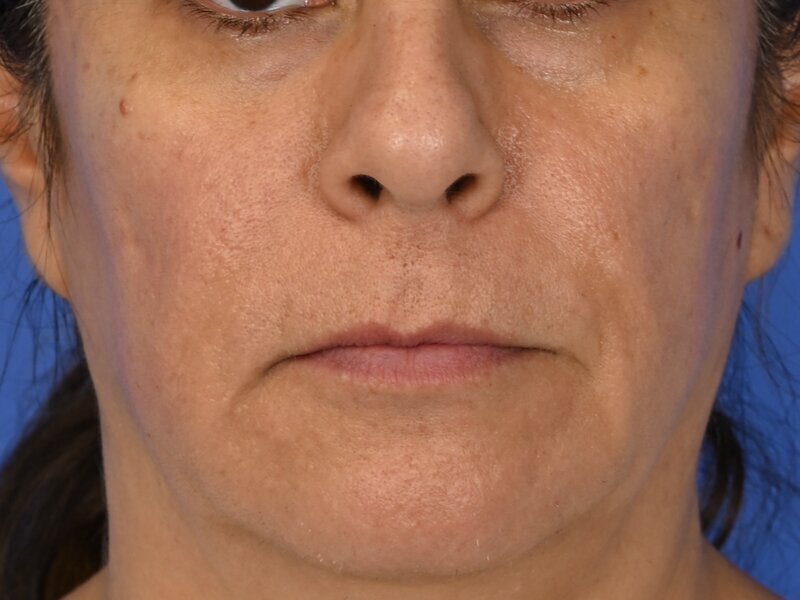 Lip Lift Before & After Image