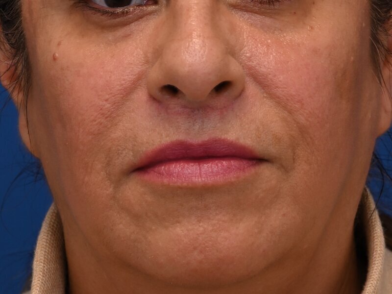 Lip Lift Before & After Image
