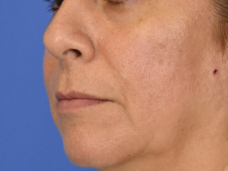 Lip Lift Before & After Image