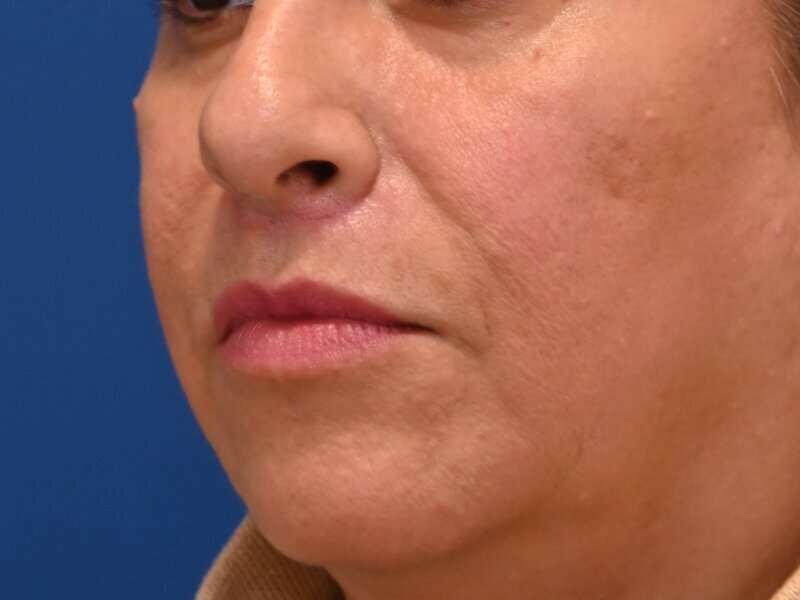 Lip Lift Before & After Image