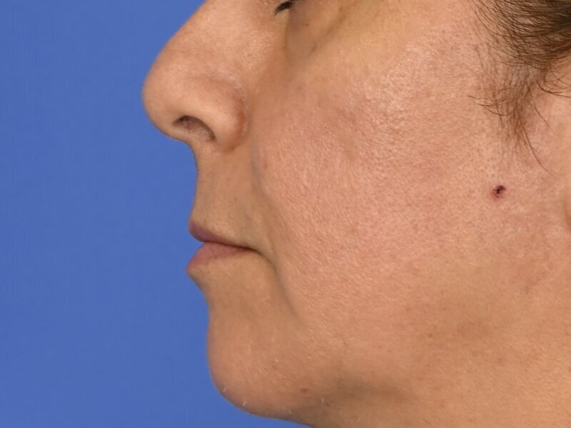 Lip Lift Before & After Image