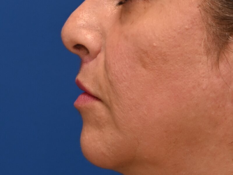 Lip Lift Before & After Image