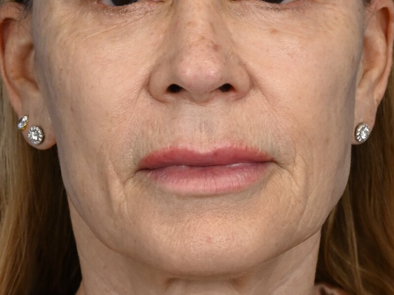 Lip Lift Before & After Image