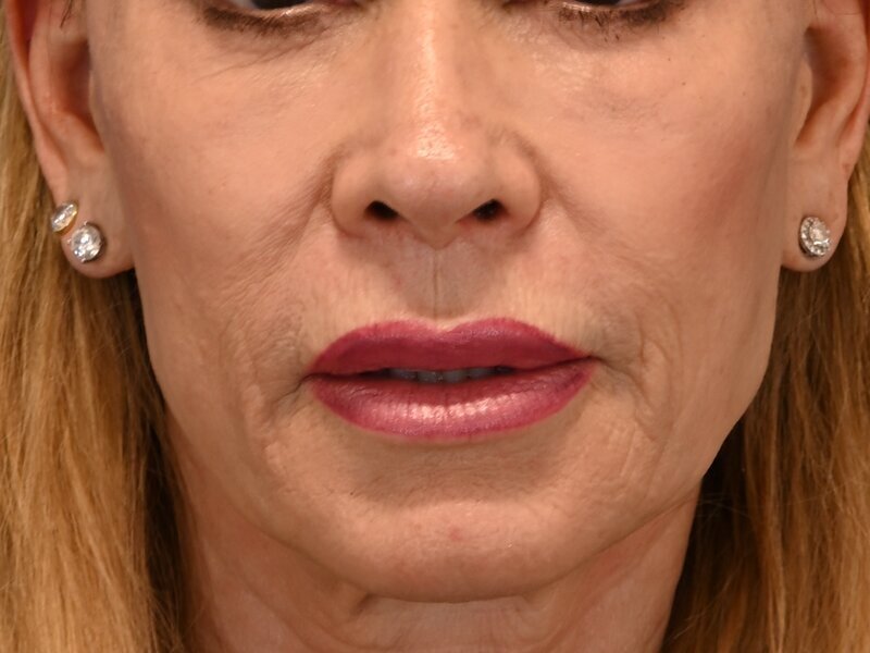 Lip Lift Before & After Image
