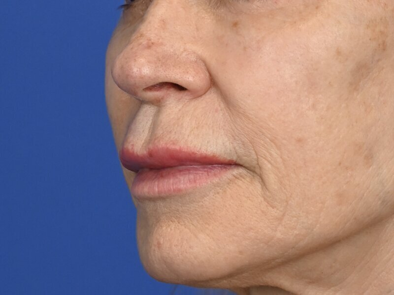 Lip Lift Before & After Image
