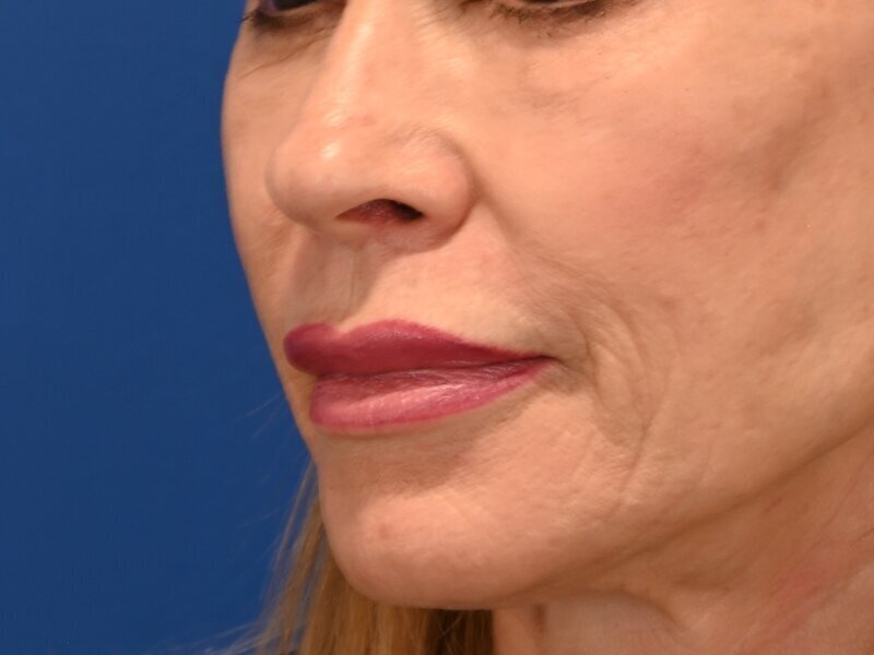 Lip Lift Before & After Image