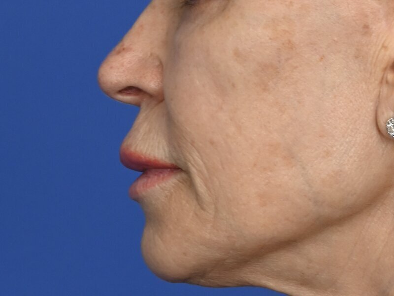 Lip Lift Before & After Image