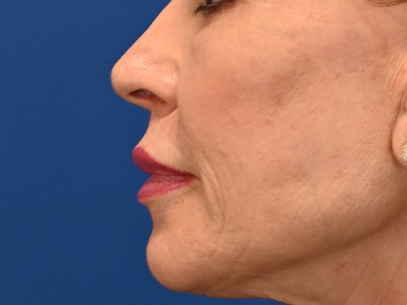 Lip Lift Before & After Image