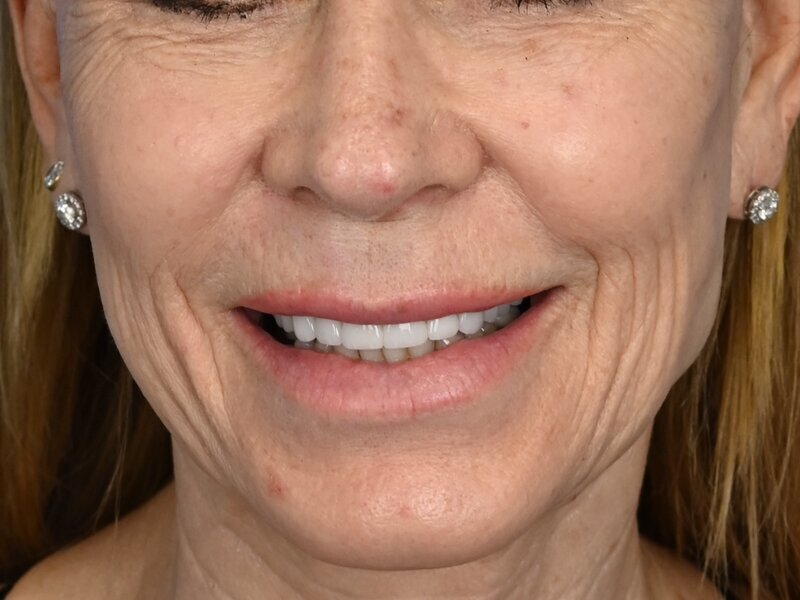 Lip Lift Before & After Image