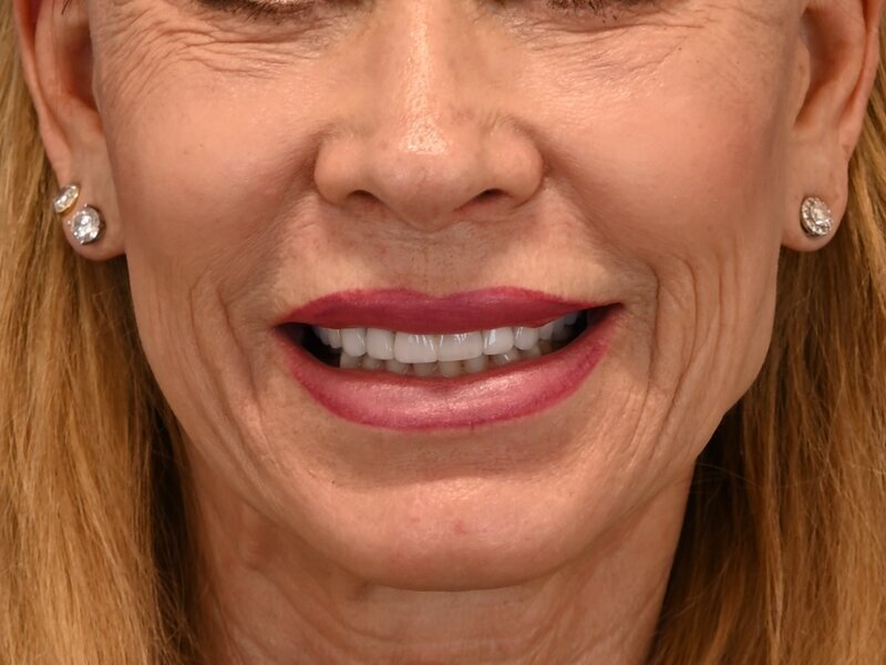 Lip Lift Before & After Image