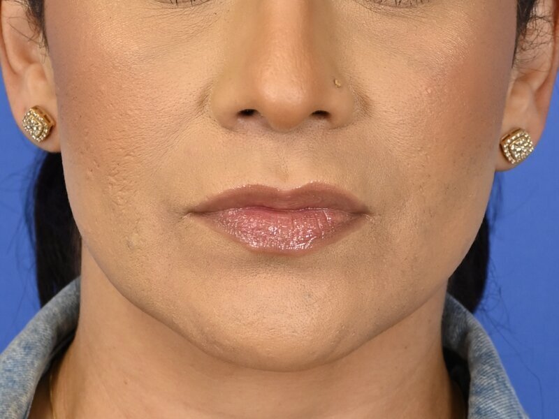 Lip Lift Before & After Image