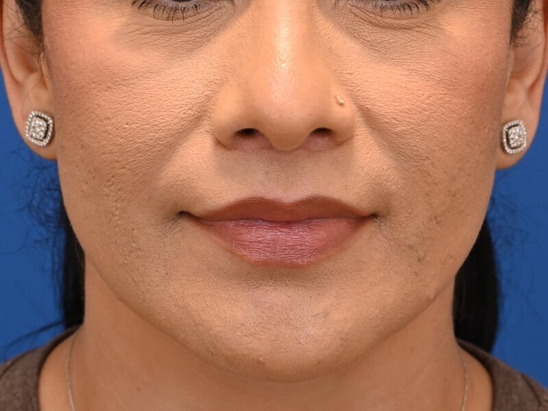 Lip Lift Before & After Image