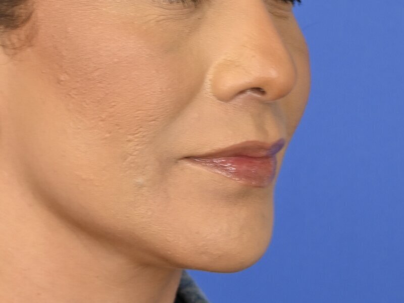 Lip Lift Before & After Image