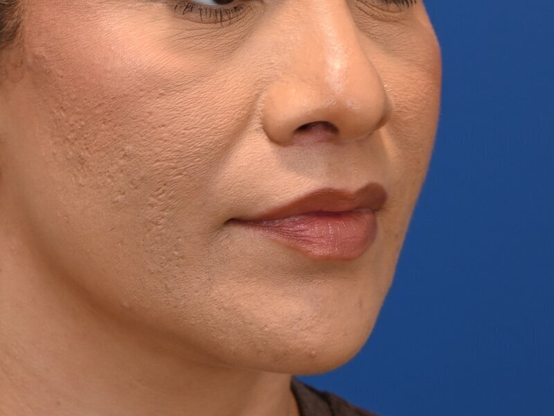 Lip Lift Before & After Image