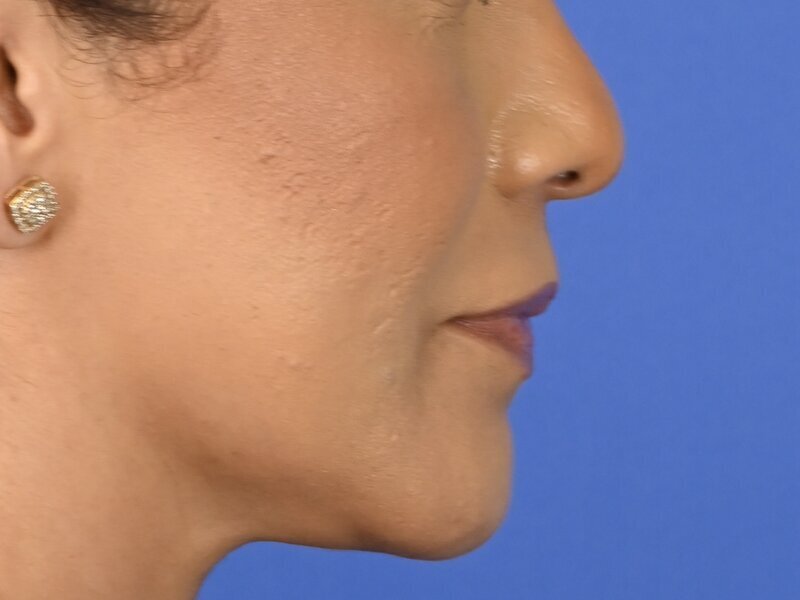 Lip Lift Before & After Image