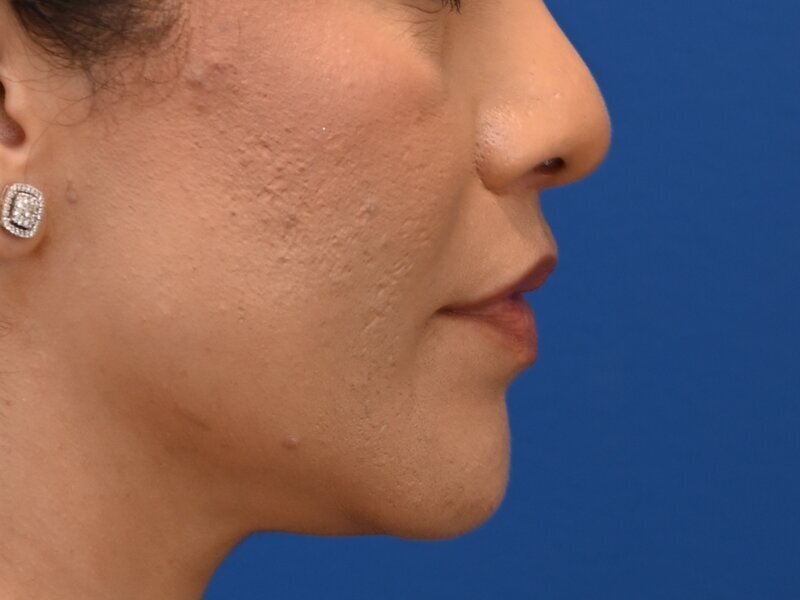Lip Lift Before & After Image