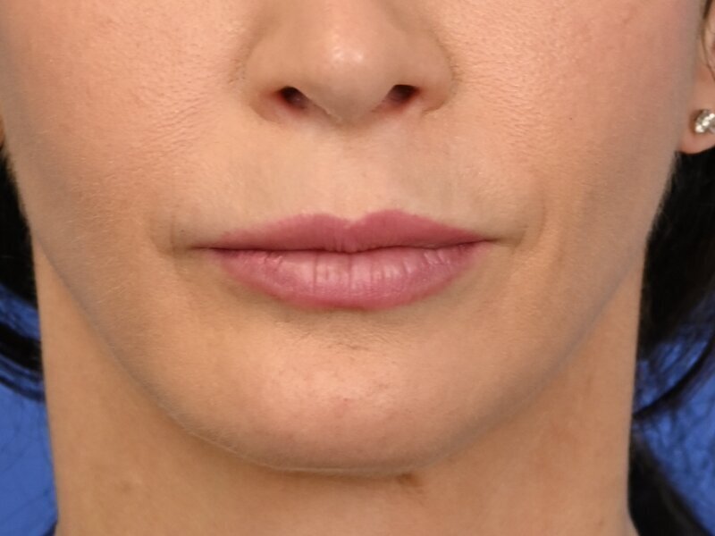 Lip Lift Before & After Image
