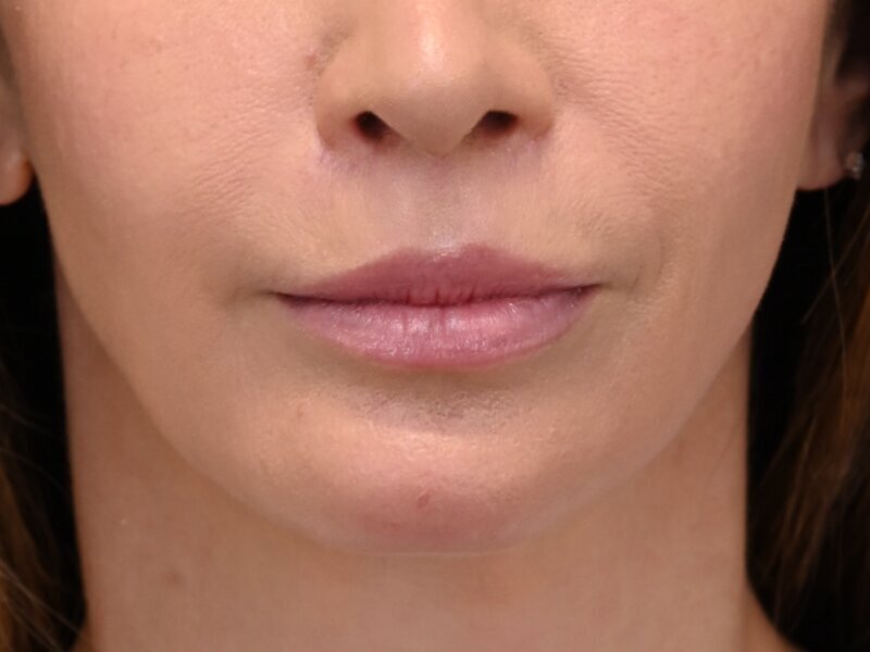 Lip Lift Before & After Image