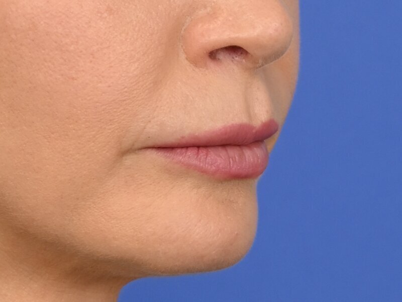 Lip Lift Before & After Image