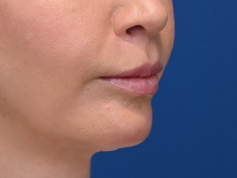 Lip Lift Before & After Image