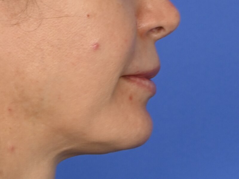 Lip Lift Before & After Image