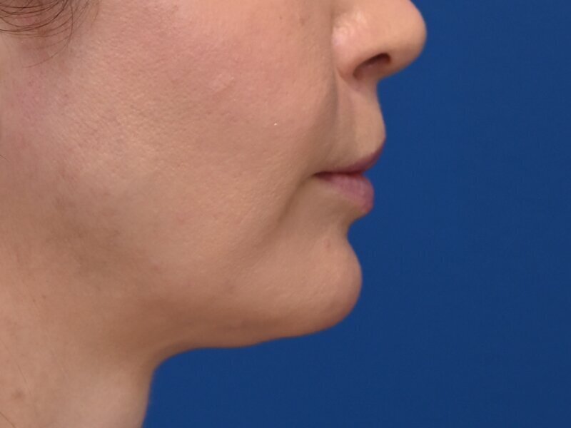 Lip Lift Before & After Image