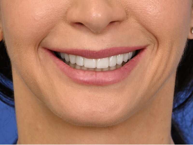 Lip Lift Before & After Image