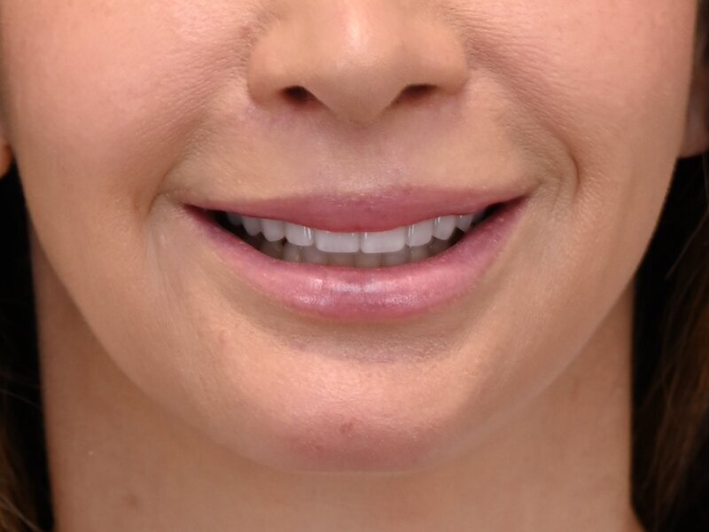 Lip Lift Before & After Image