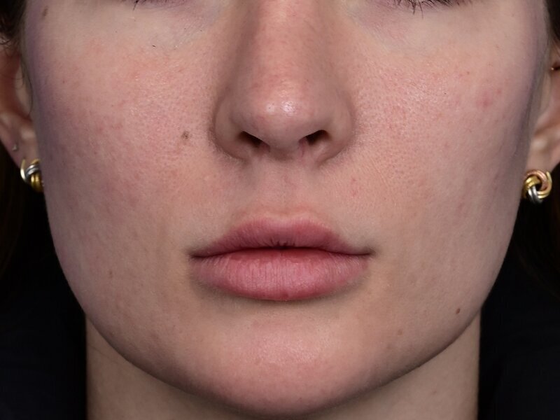 Lip Lift Before & After Image