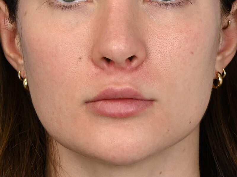 Lip Lift Before & After Image