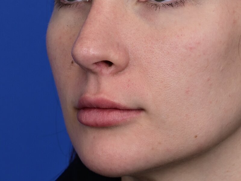 Lip Lift Before & After Image