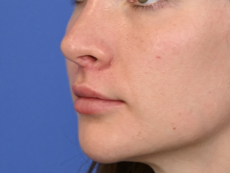 Lip Lift Before & After Image