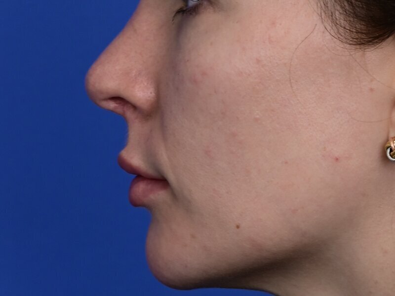 Lip Lift Before & After Image