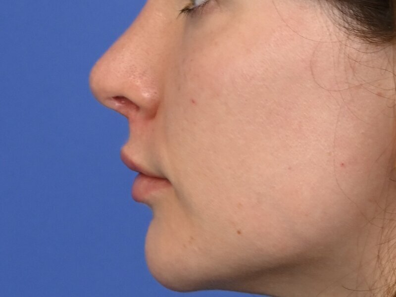 Lip Lift Before & After Image