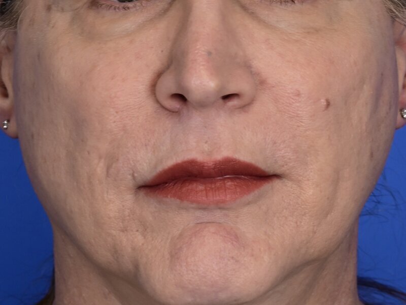 Lip Lift Before & After Image