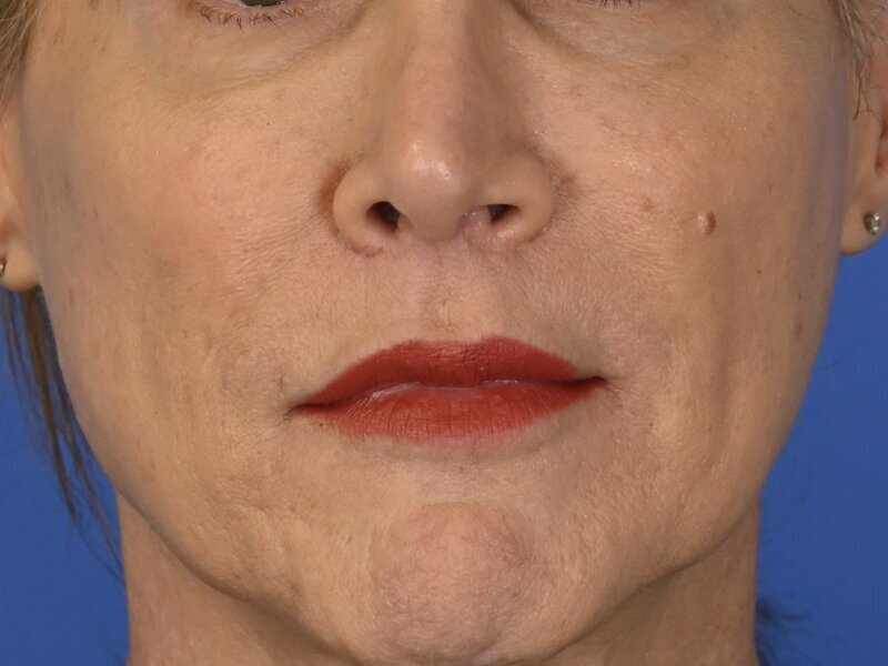Lip Lift Before & After Image