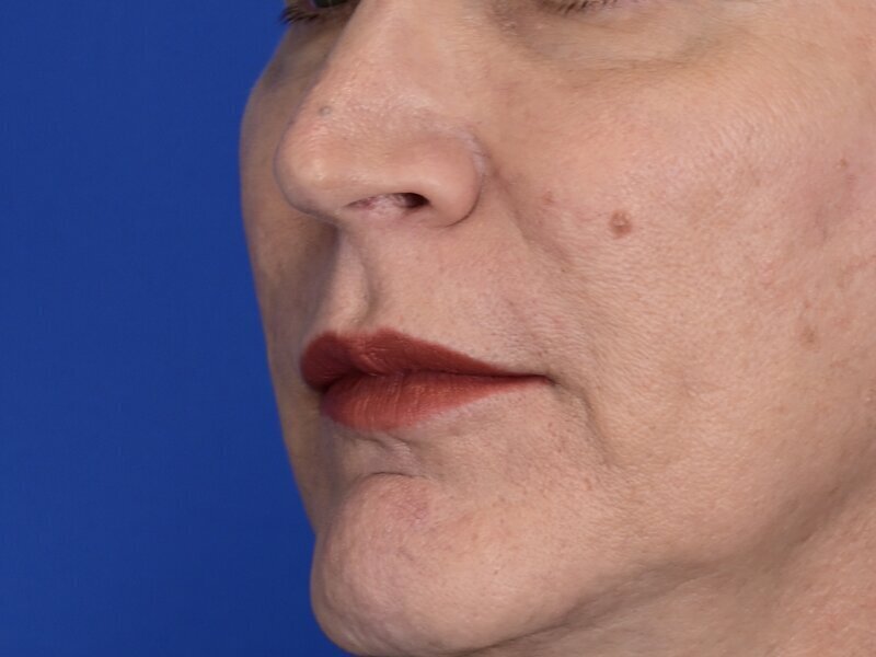 Lip Lift Before & After Image