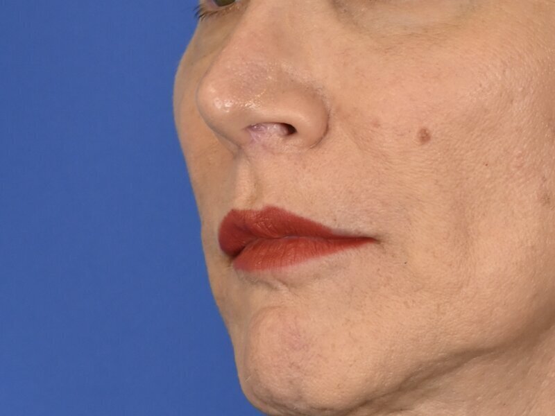Lip Lift Before & After Image