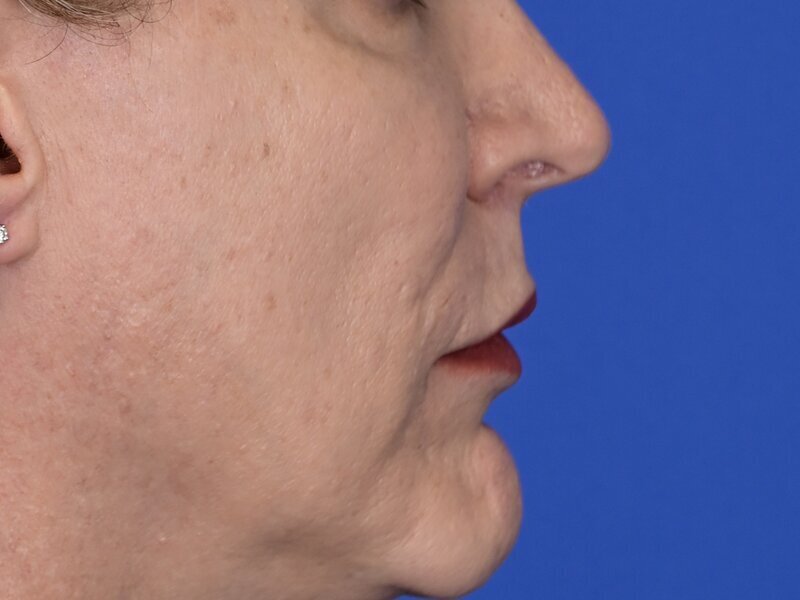 Lip Lift Before & After Image