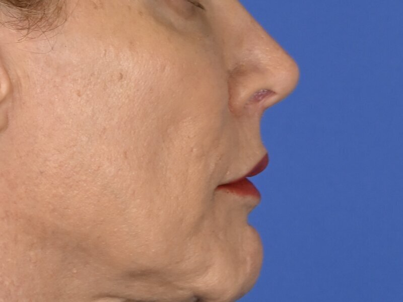 Lip Lift Before & After Image