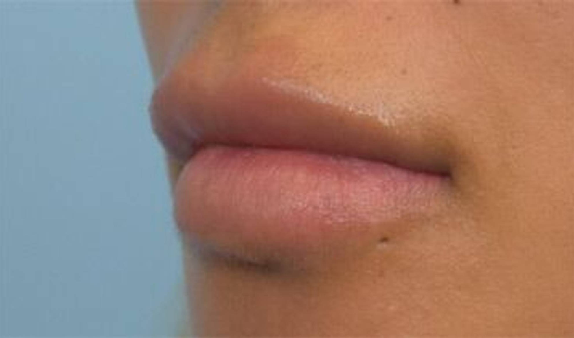 Lip Reduction Before & After Image