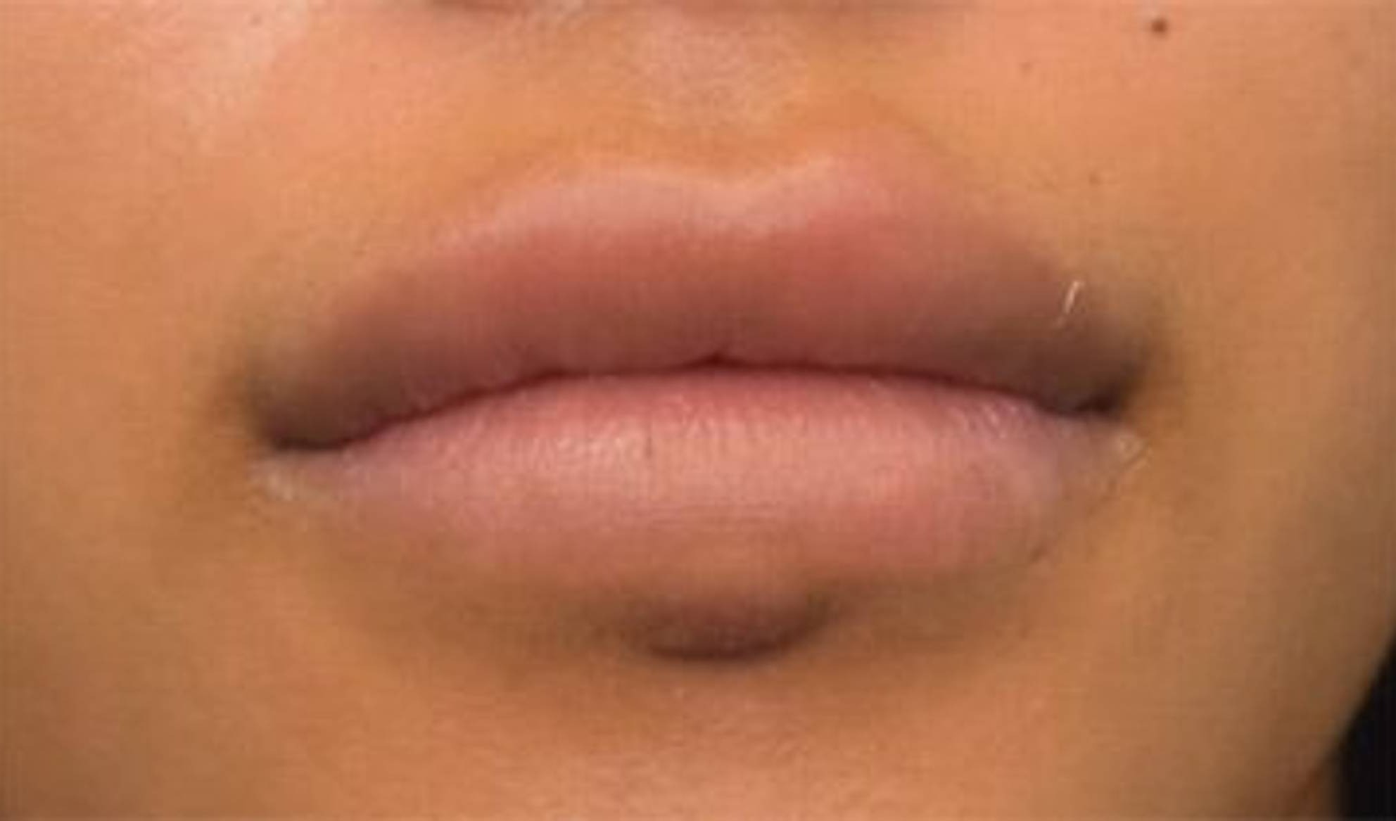 Lip Reduction Before & After Image