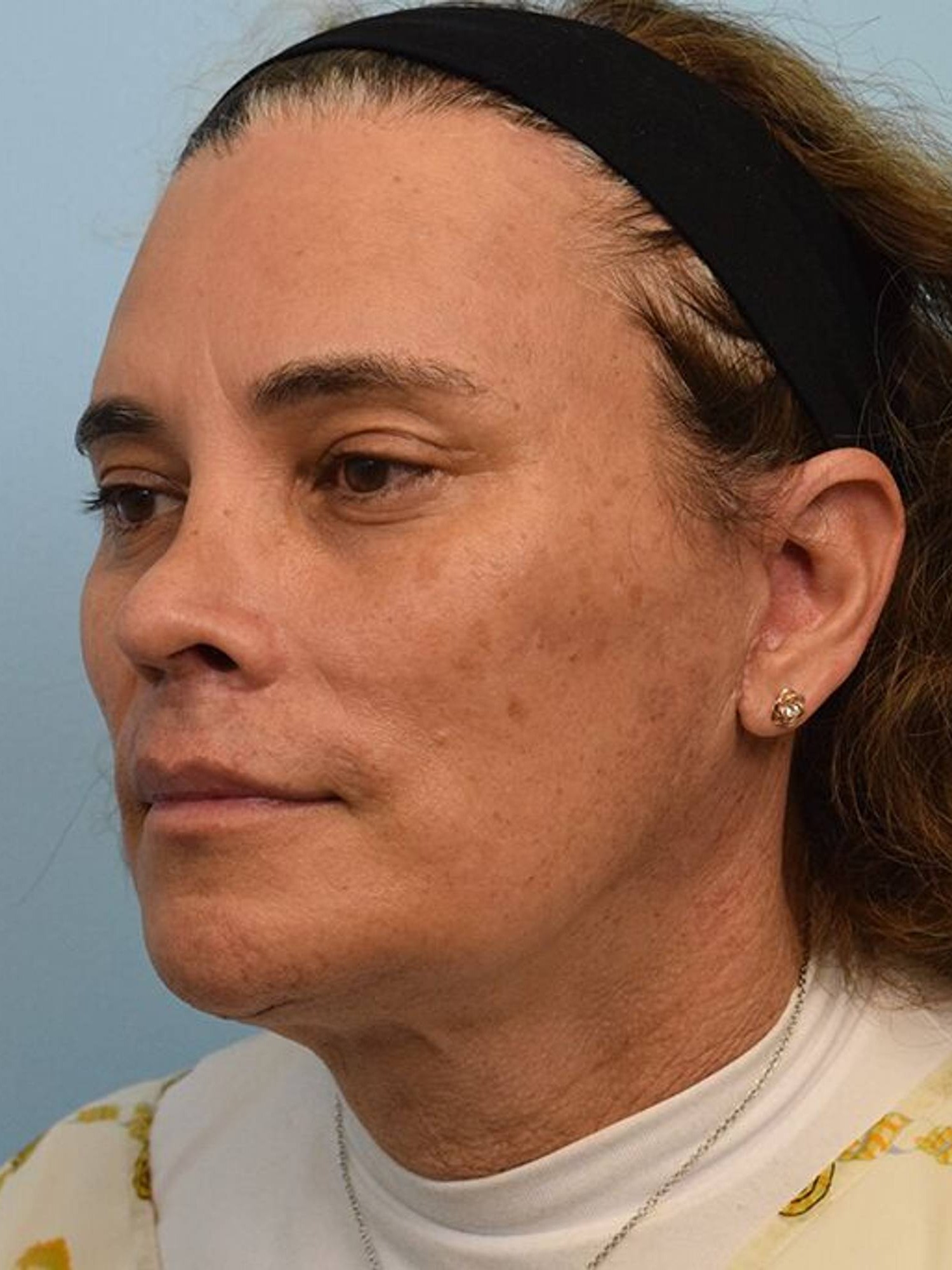 Deep Plane Necklift Before & After Image