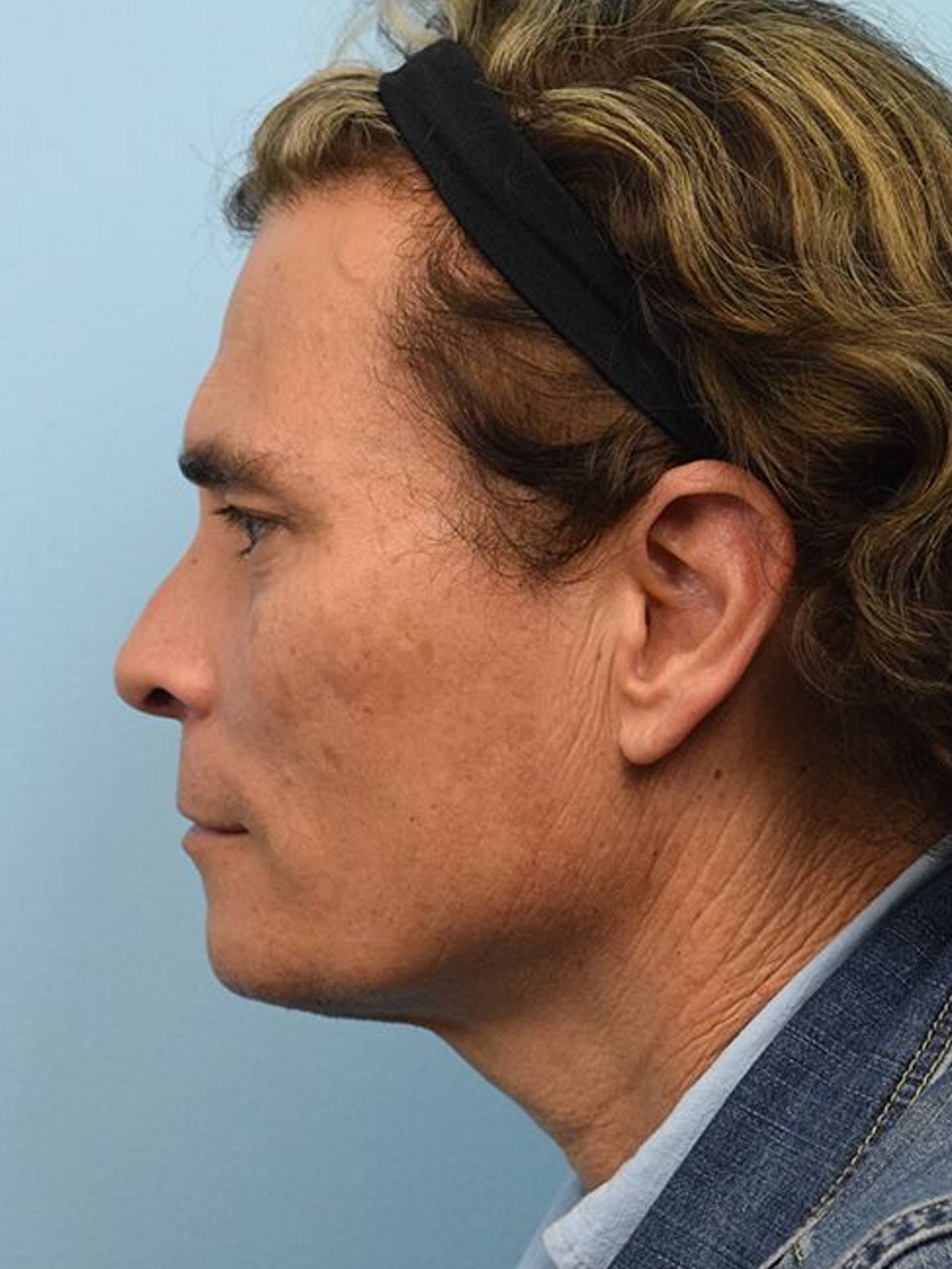 Deep Plane Necklift Before & After Image