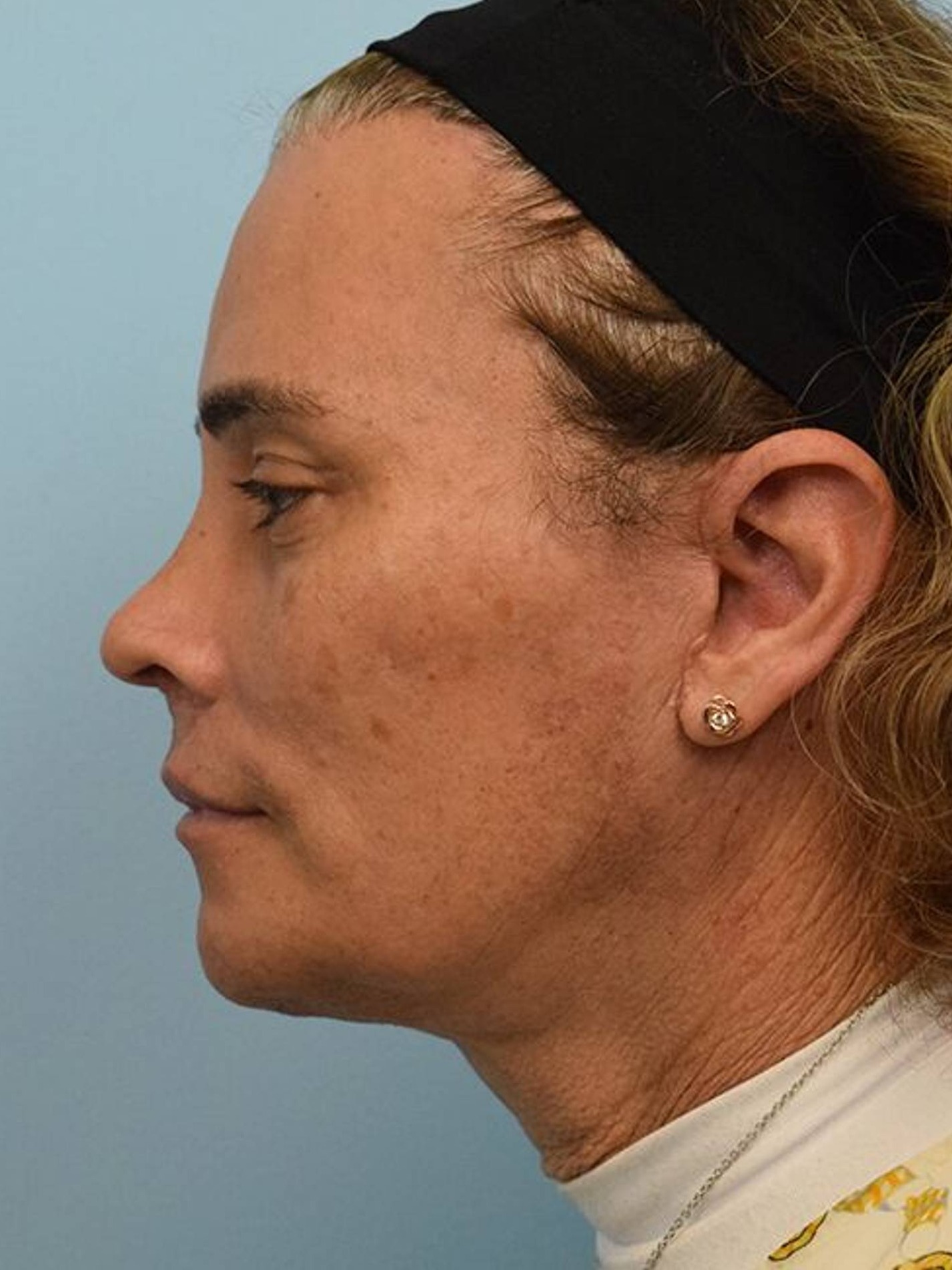 Deep Plane Necklift Before & After Image