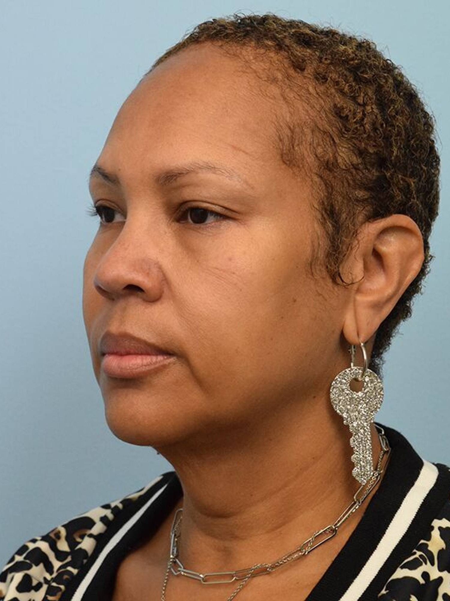 Deep Plane Necklift Before & After Image